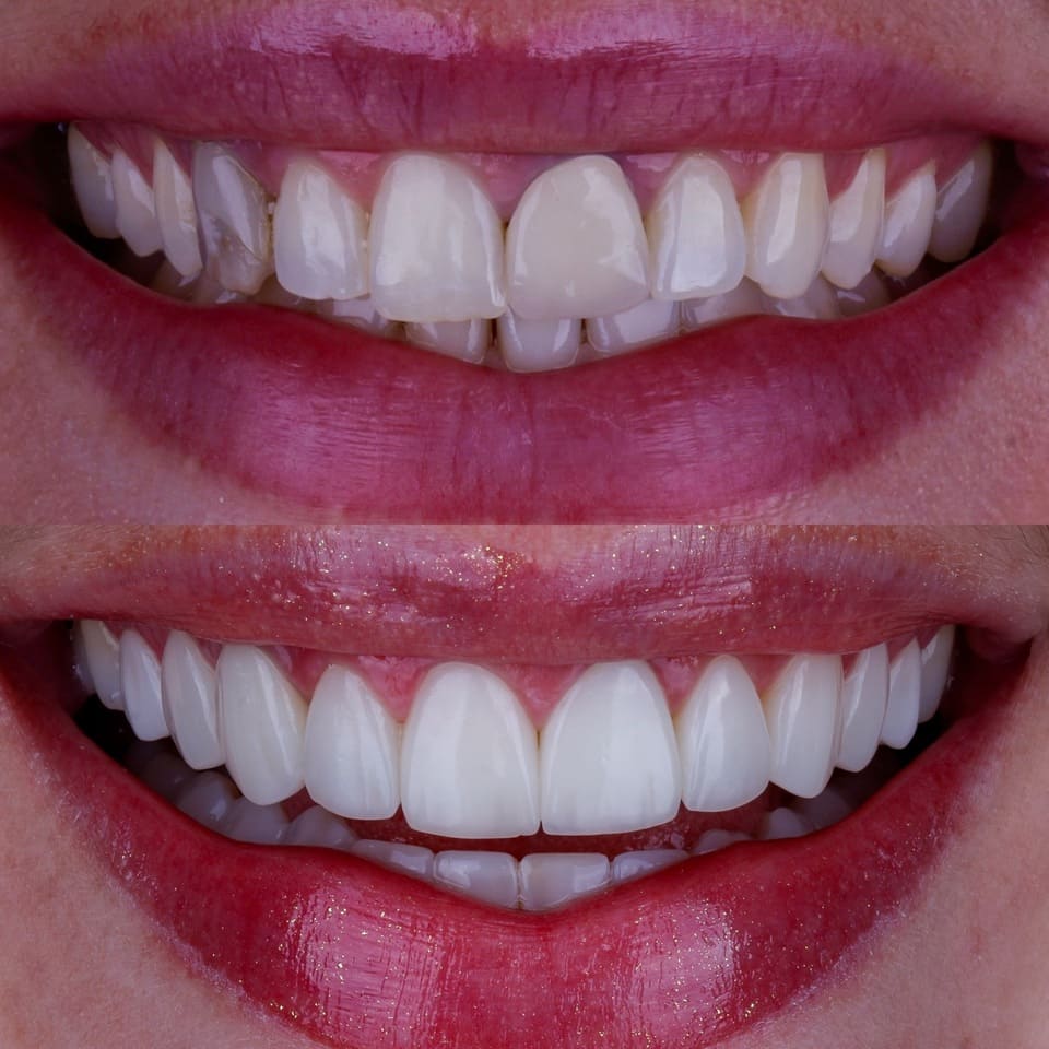 faceta-hibrida-valor-12