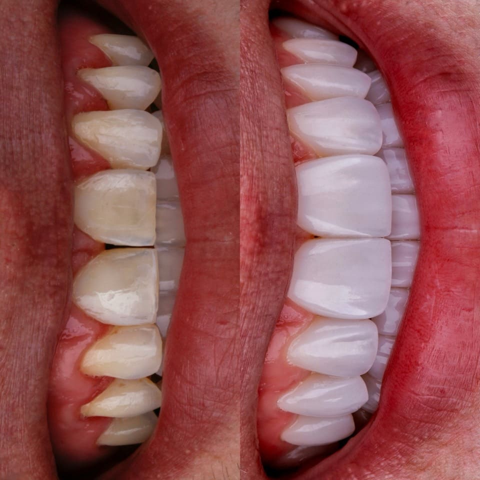 Antes e depois com facetas de resina híbridas e sorriso natural, realizado na clínica Blanvur em Curitiba.