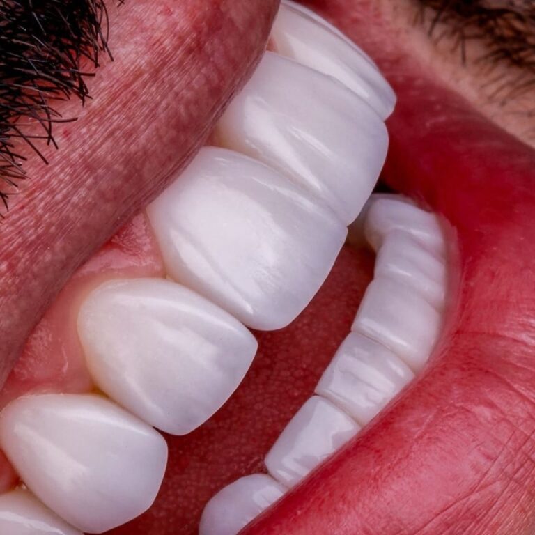 Lentes de Resina Híbridas em Curitiba. clínica Blanvur Odontologia