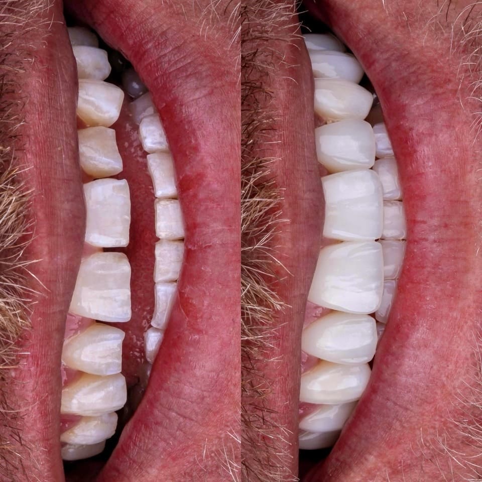 resultado-final-naturalidade-resina-blanvur-curitiba-04