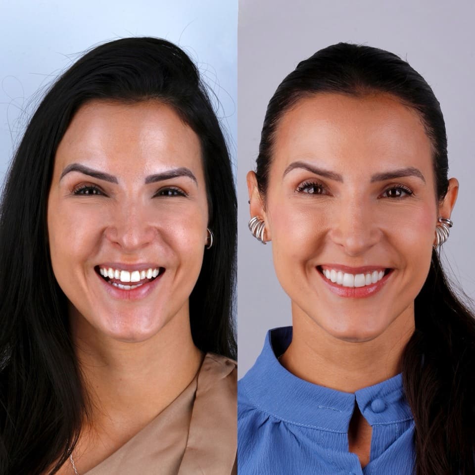transformacao-sorriso-antes-e-depois-porcelana-blanvur-curitiba-05