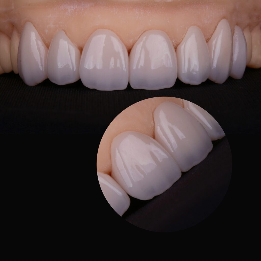 Como as facetas híbridas são produzidas2