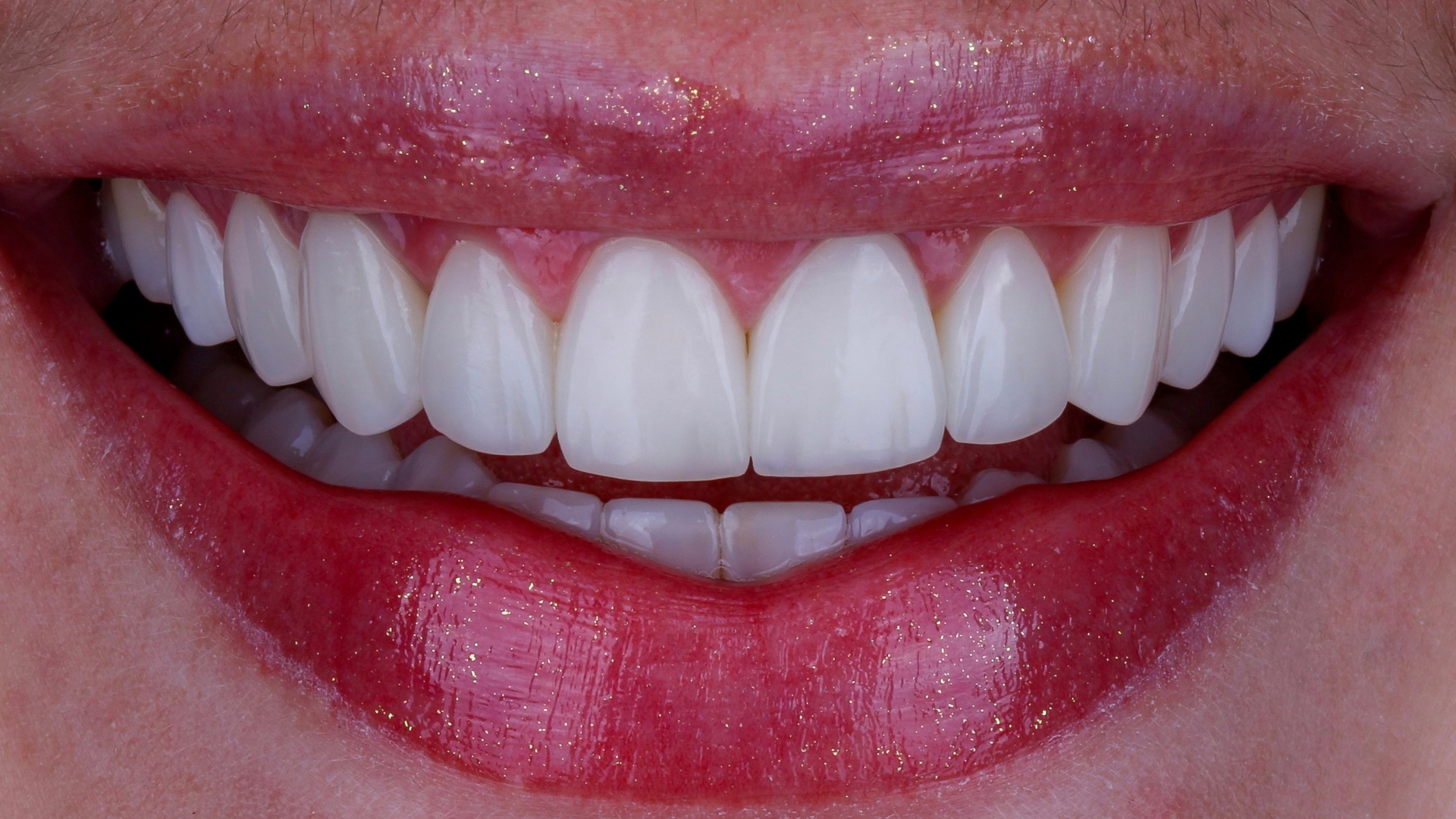 Faceta de resina quanto custa e o que você precisa saber