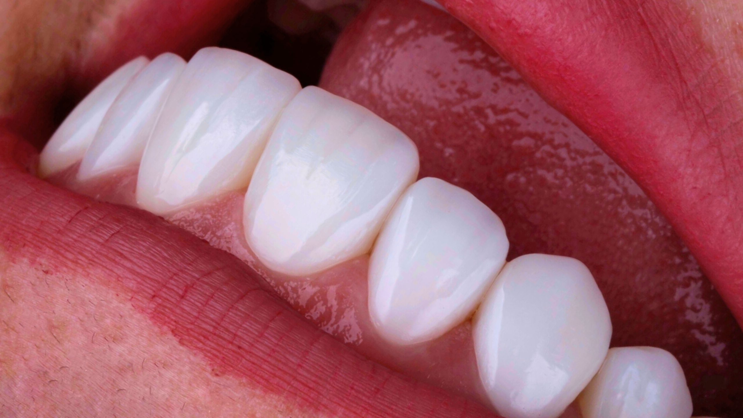 Facetas Híbridas O que são e por que estão revolucionando a odontologia estética