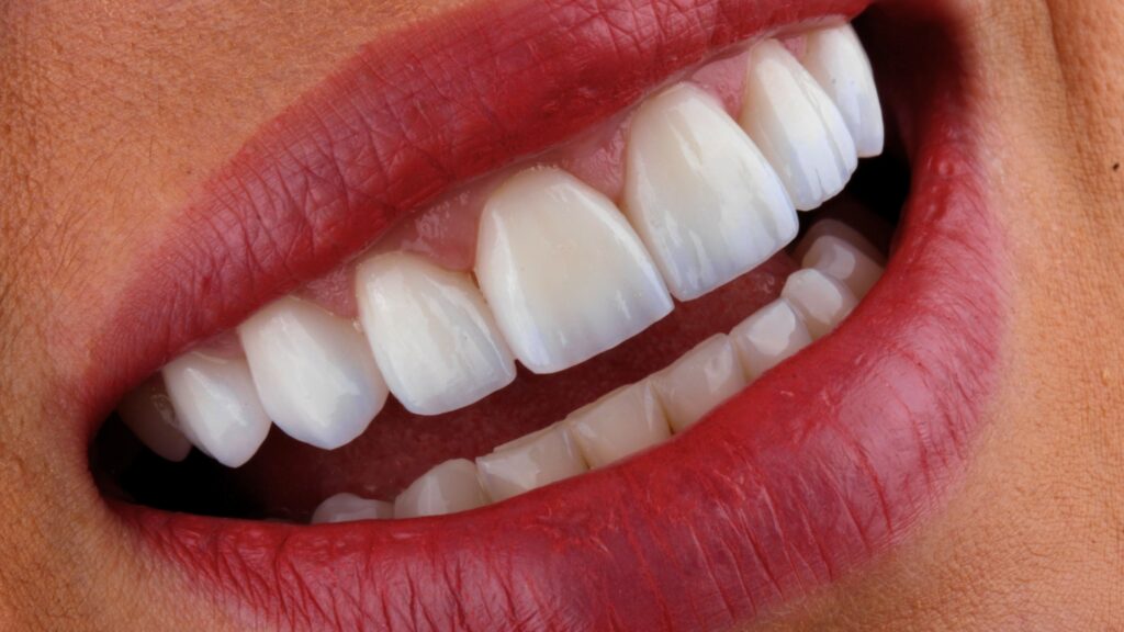 Facetas de porcelana 