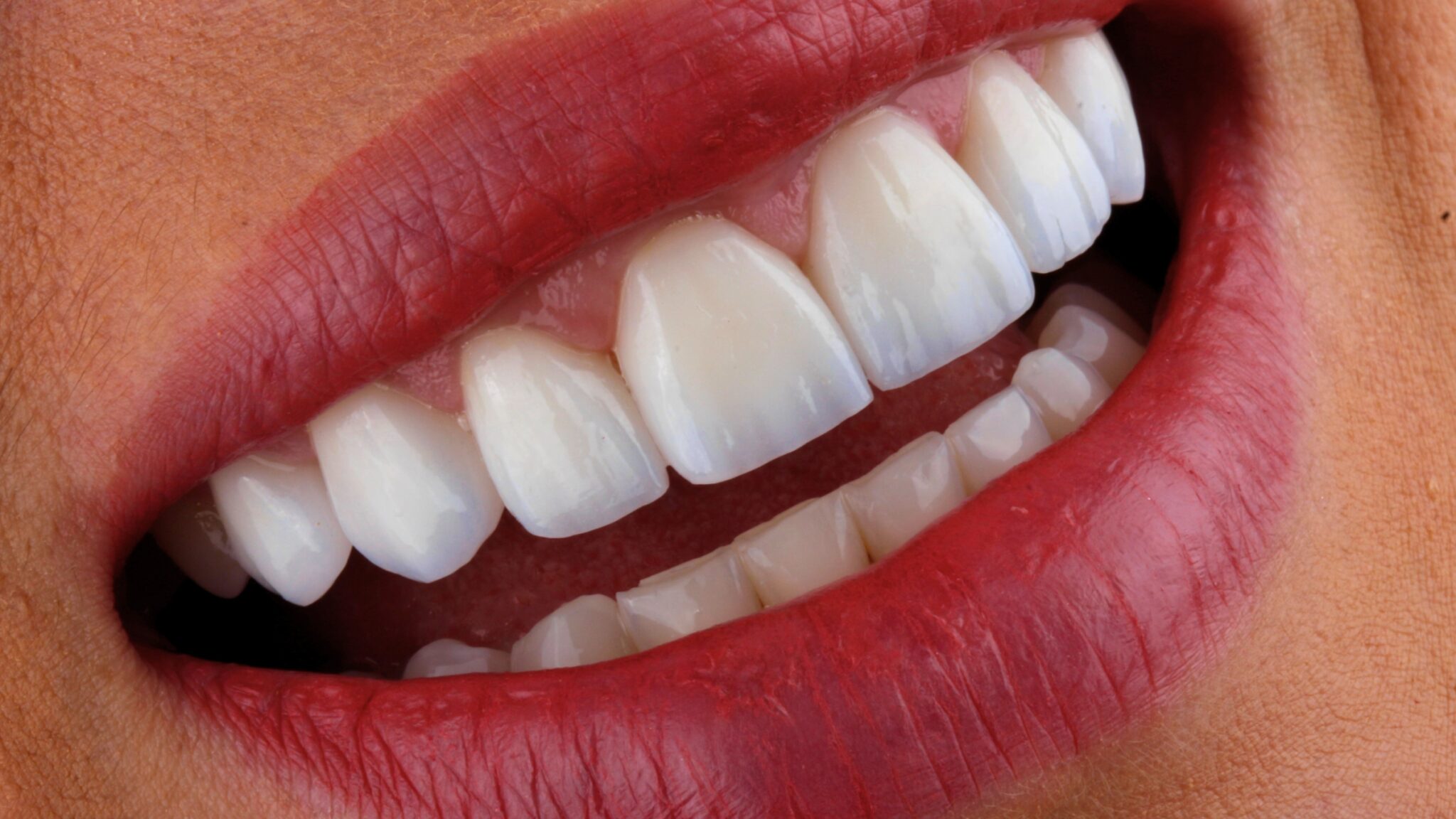 Facetas de porcelana em Curitiba