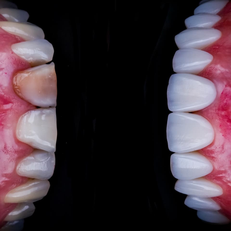 Facetas de resina - lentes dentais