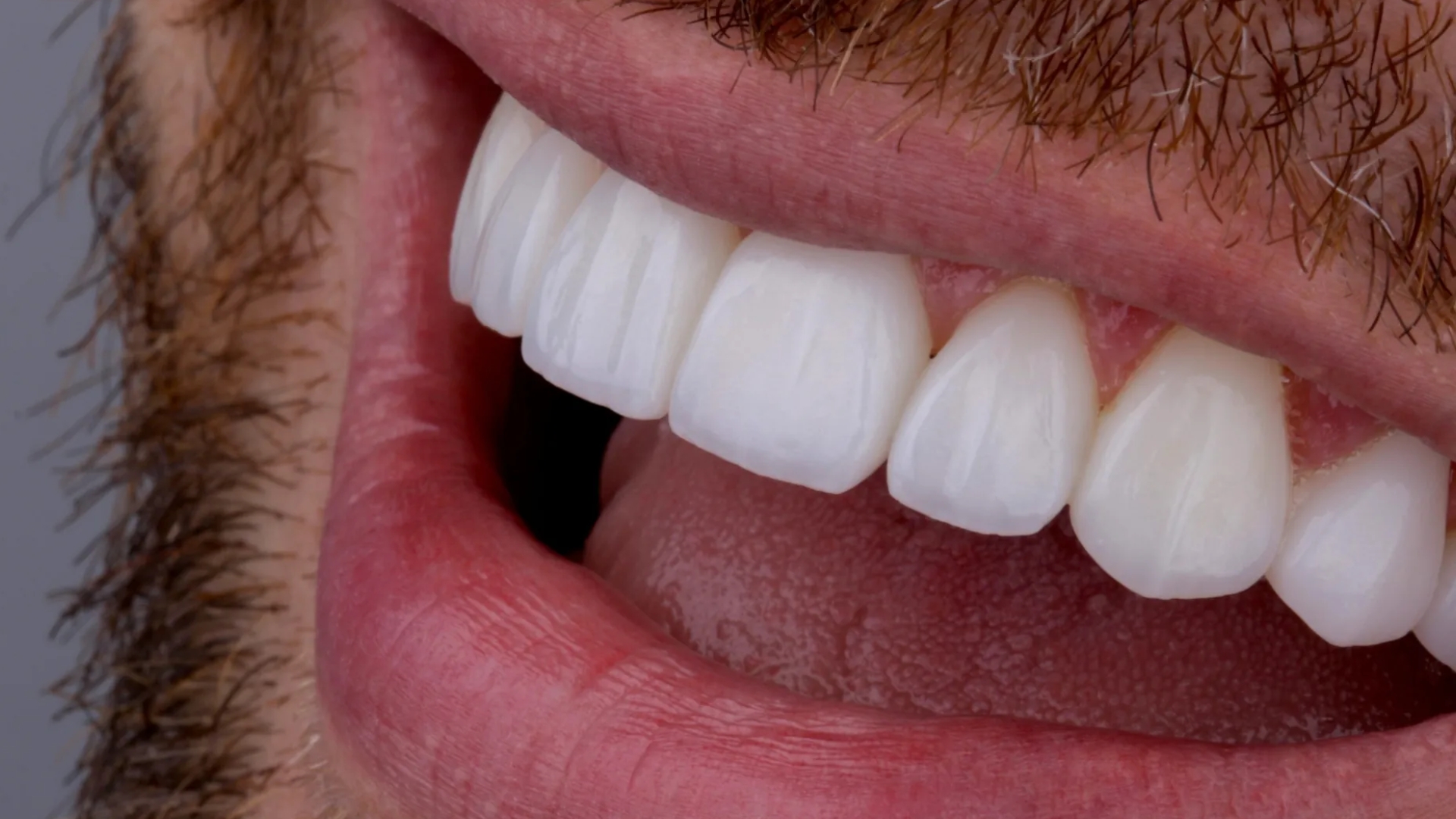 Faceta de resina ou porcelana qual é a melhor